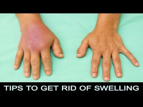 7 Tips How To Get Rid Of Swelling Fast
