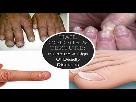 Nail Colour & Texture:  It Can Be A Sign Of These Deadly Diseases!