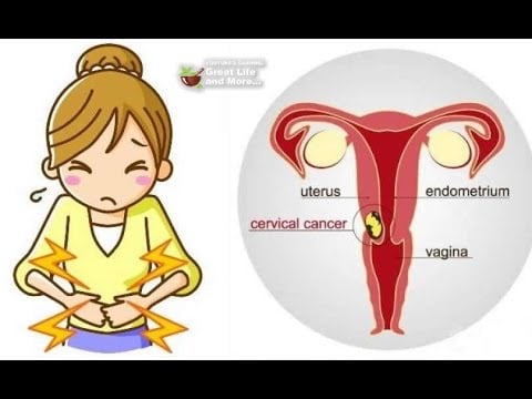 Most Women Miss These 3 Early Signs Of Cervical Cancer!