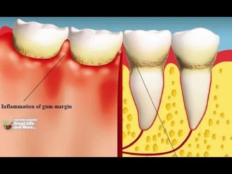 Gum Diseases Are Silent Killers – Here Is How You Can Heal Them!
